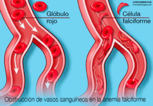 Obstrucción de vasos sanguíneos en la anemia falciforme